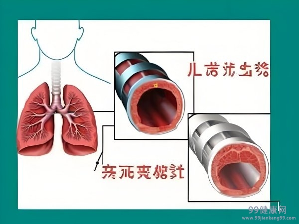 支气管扩张最新治疗策略与方案探讨